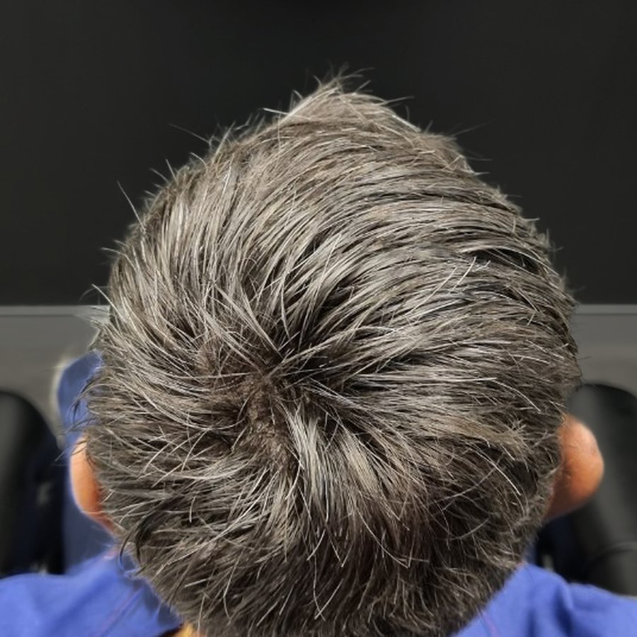 Close-up of a client's hairline after their Tuffs hair system