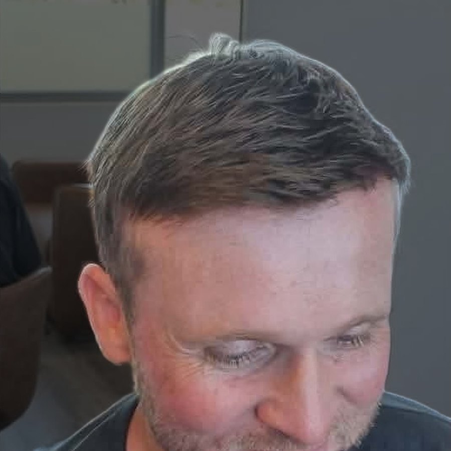 Close-up of a client's hairline after their Tuffs hair system